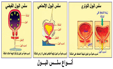 أنواعه ثلاثة.. وطرق علاجه أربعة.. منها رفع مجرى البول وعنق المثانة.. وكلها تعتمد على التشخيص الدقيق 