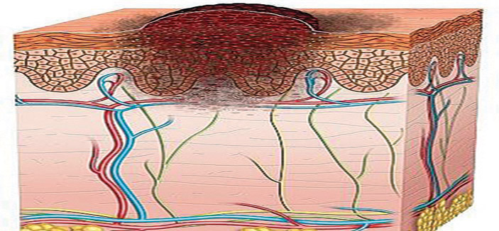 سبل «بسيطة» للوقاية من سرطان الجلد 