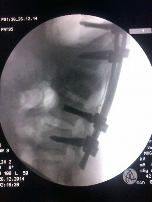  أشعة المريض بعد تثبيت الفقرات