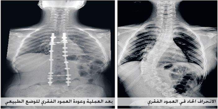 جراحة لإصلاح انحراف حاد بالعمود الفقري لطفل بـ«الحبيب» 