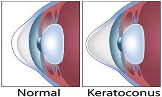 استشاري عيون يحذّر من تحدّب القرنيّة 