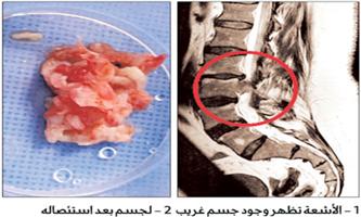 جراحة مجهرية في «العمود الفقري» تعيد لسيدة القدرة على الحركة 