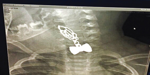إنقاذ حياة طفل ابتلع سلسالاً معدنياً بتبوك 