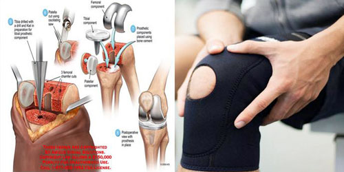 الأطباء ينصحون بجعل جراحة استبدال الركبة الخيار الأخير 