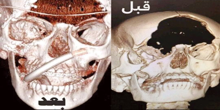 تعرضت لحادث مروري أدى لفقد عظم الجبهة 