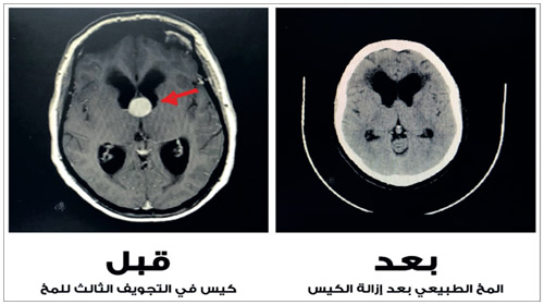 استخدم أحدث تقنيات المناظير في عملية جراحية بالمخ 