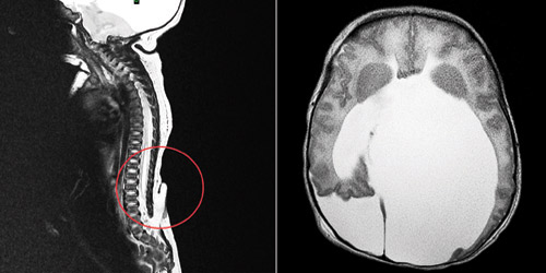 صورة تظهر التشوه الخلقي بالعمود الفقري وتجمع المياه داخل الجمجمة