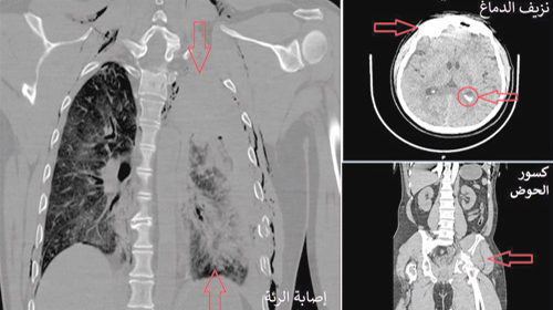 أصيب بكسور ونزيف بالجمجمة والرئة والحوض وفقدان الوعي 