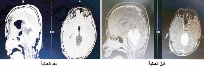 عانى من ورم دماغي ضخم 