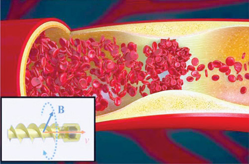 تطوير روبوت «يسبح» عبر الأوعية الدموية لتفتيت الجلطات 