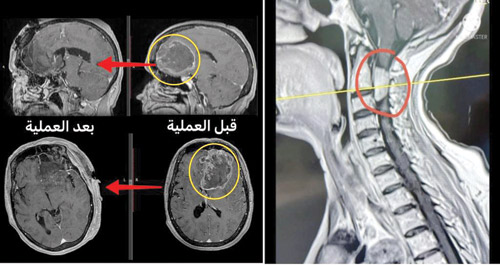 باستخدام أجهزة الملاحة العصبية والميكروسكوب المتطور 