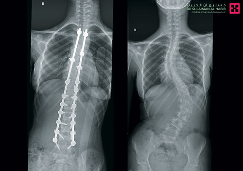 جراحة ناجحة لـ«فتاة» بمجمع الدكتور سليمان الحبيب لتصحيح تقوسات حادة بالفقرات القطنية والصدرية 