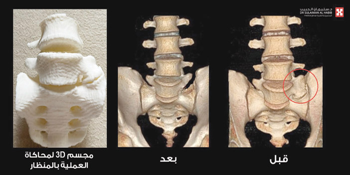 مستشفى د.سليمان الحبيب بالريان يُجري جراحة نادرة بالمنظار أحادي القطب لإنهاء معاناة عشريني من الآلام 