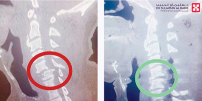 مستشفى الدكتور سليمان الحبيب بالقصيم يعيد الأمل لـ«ستيني» 