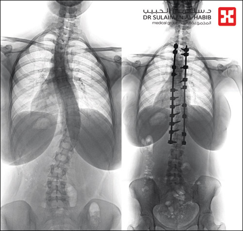 مستشفى الدكتور سليمان الحبيب بالفيحاء في جدة ينهي معاناة شابة مع انحراف في العمود الفقري 