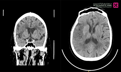 مصاب بجلطة وريدية دماغية عميقة 