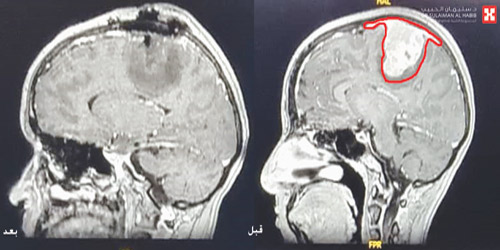 تسبب بشلل الأطراف ونوبات صرعية حادة 